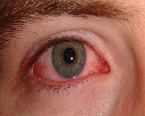 Biến chứng mắt của bệnh tiểu đường